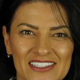 smile hollywood patient 68 after 1 patient