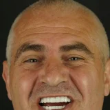 smile hollywood patient 73 after 2 patient