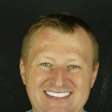 smile hollywood patient 75 after 3 patient