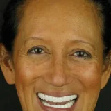 smile hollywood patient 67 after 4 patient
