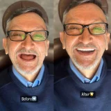 smile hollywood patient 81 smile hollywood patient 1