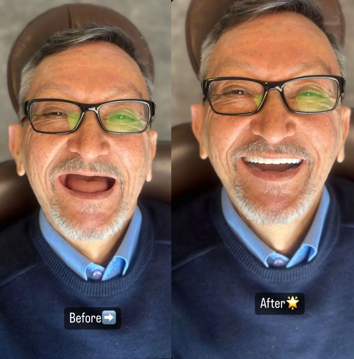 smile hollywood patient 1