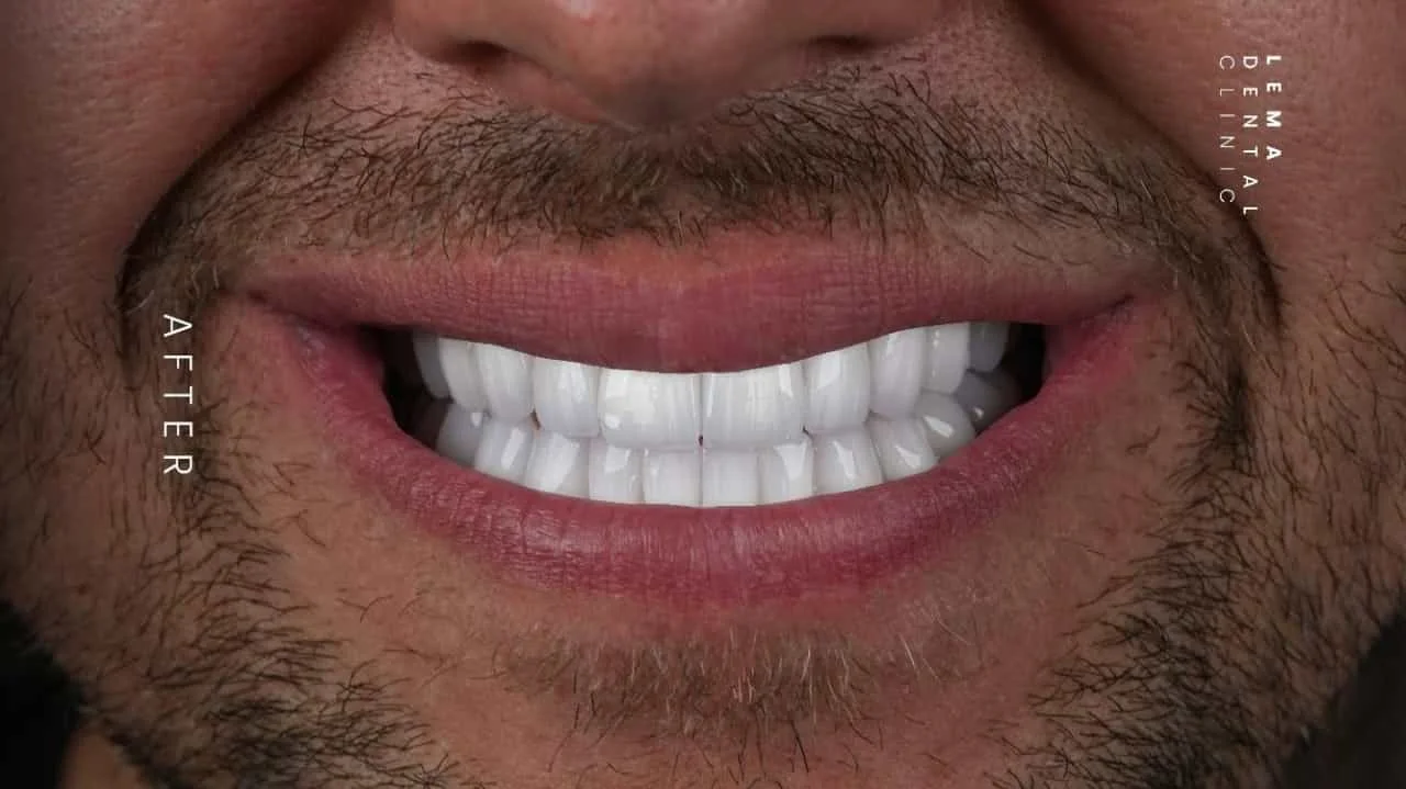 smile hollywood patient 11
