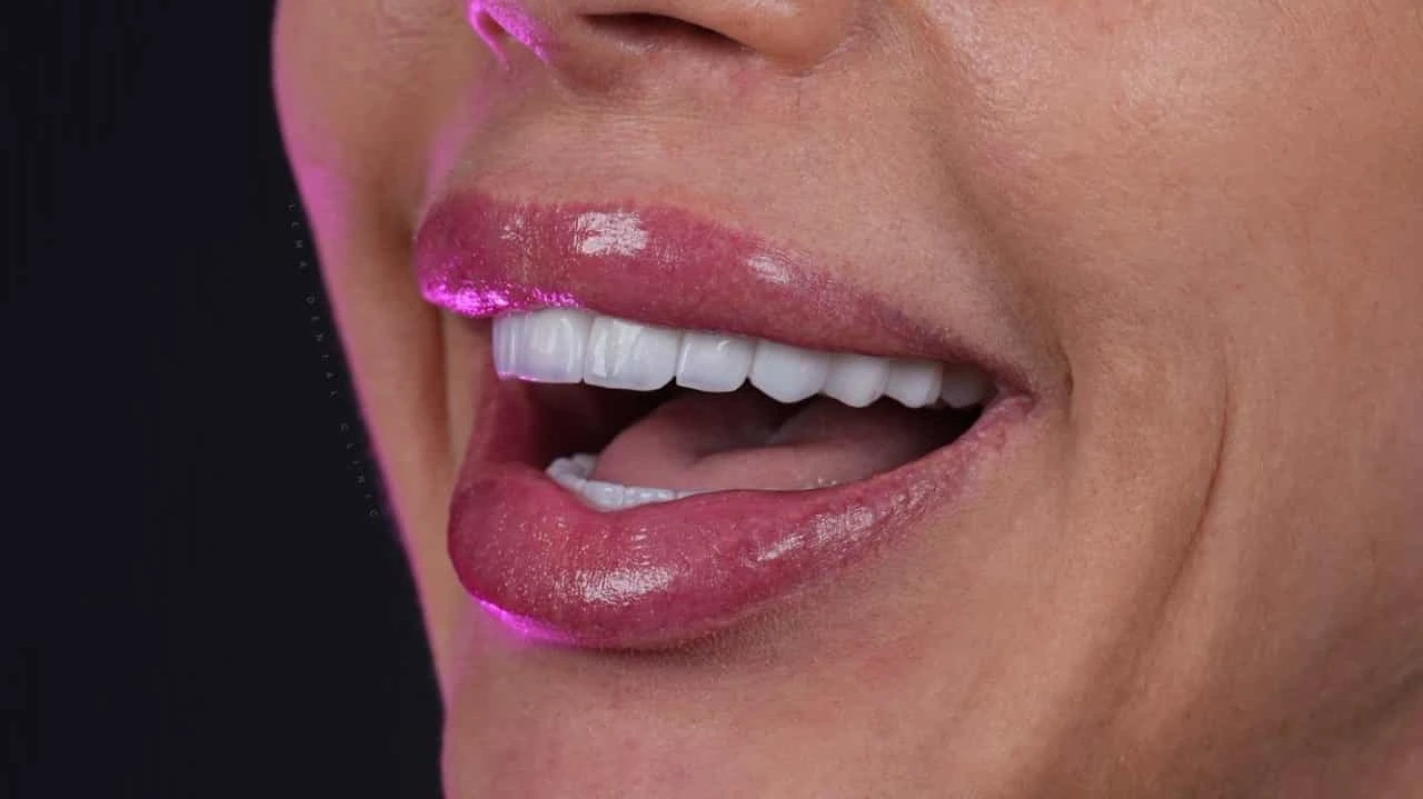 smile hollywood patient 12