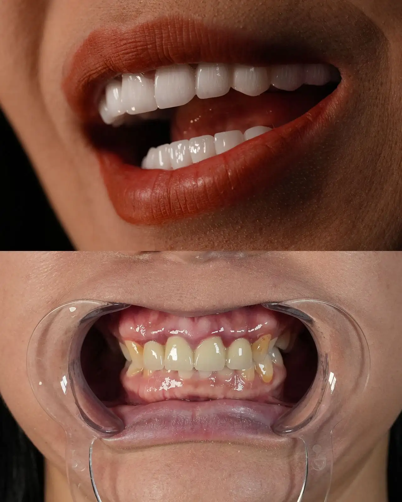 smile hollywood patient 14