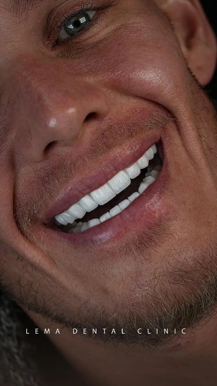 smile hollywood patient 15