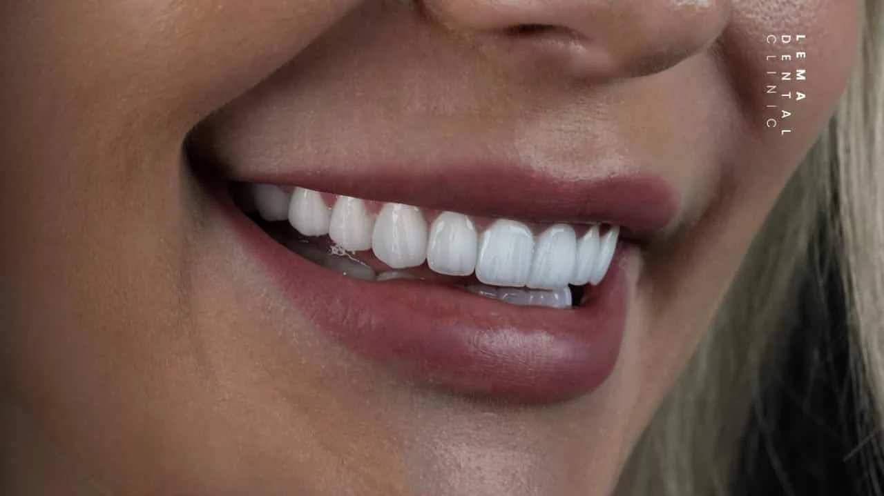 smile hollywood patient 16