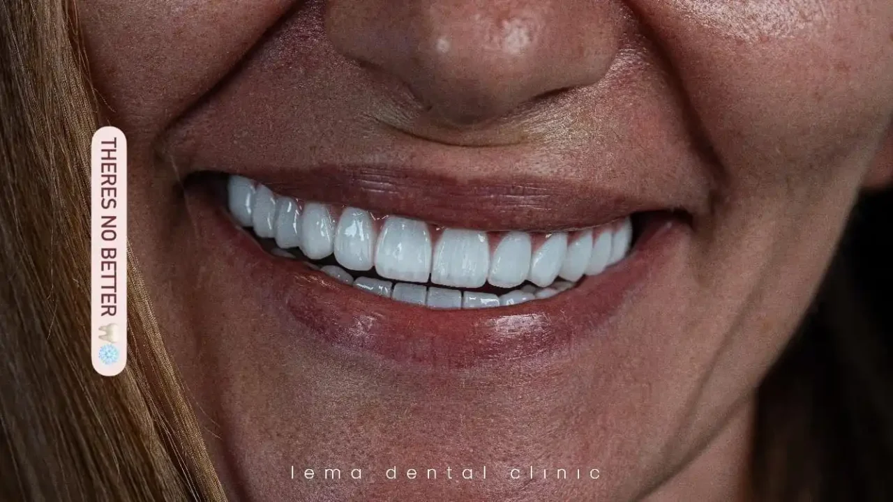 smile hollywood patient 18