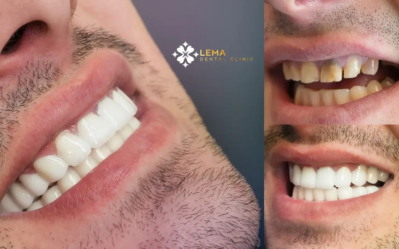 smile hollywood patient 2
