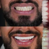 smile hollywood patient 82 smile hollywood patient 20