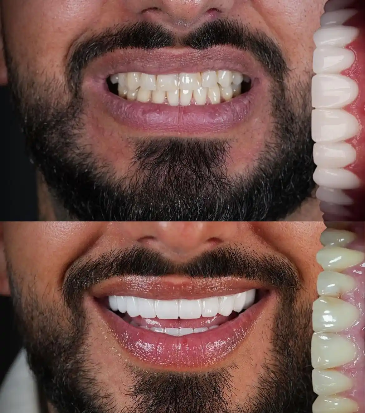 smile hollywood patient 20