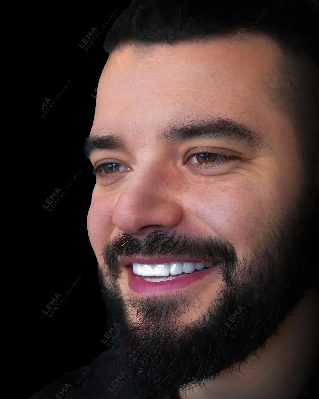 smile hollywood patient 21