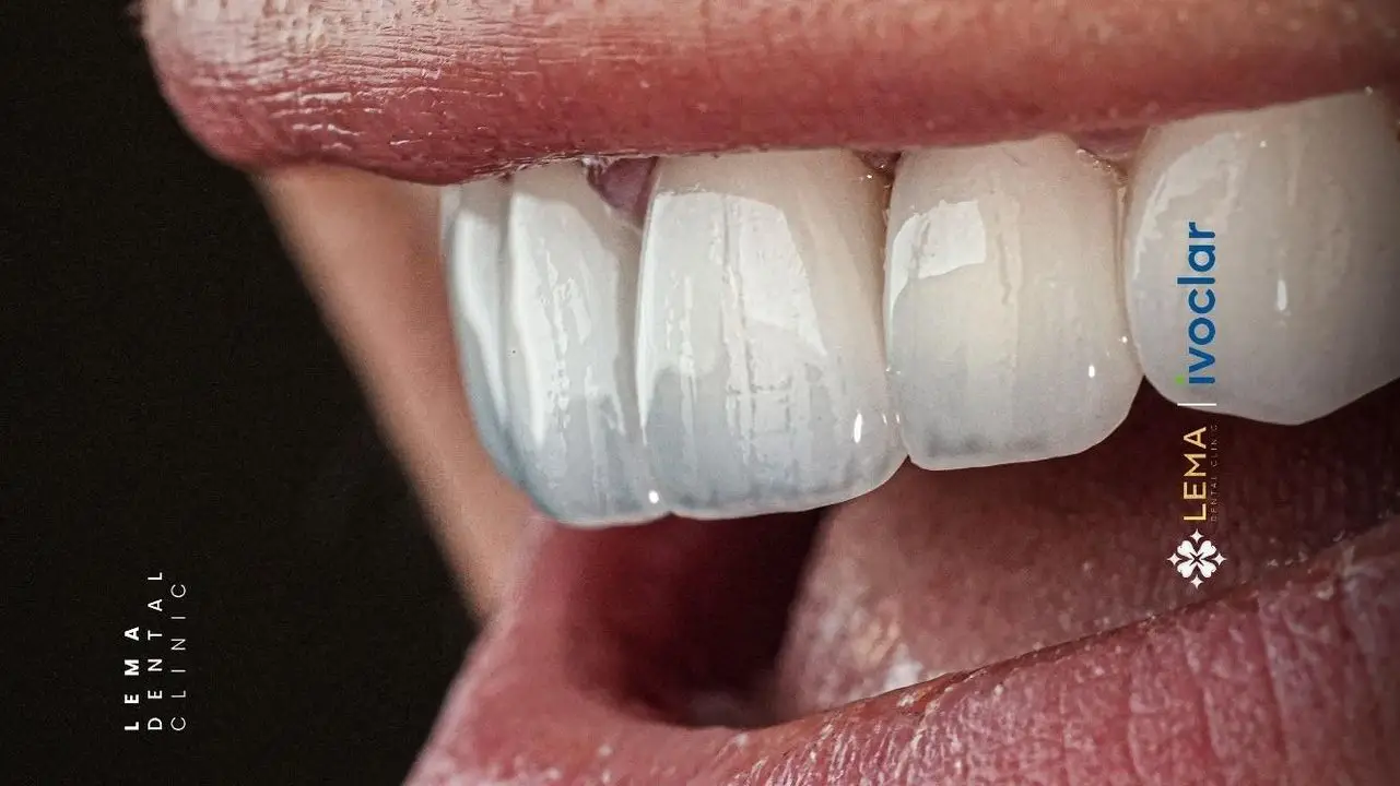 smile hollywood patient 22