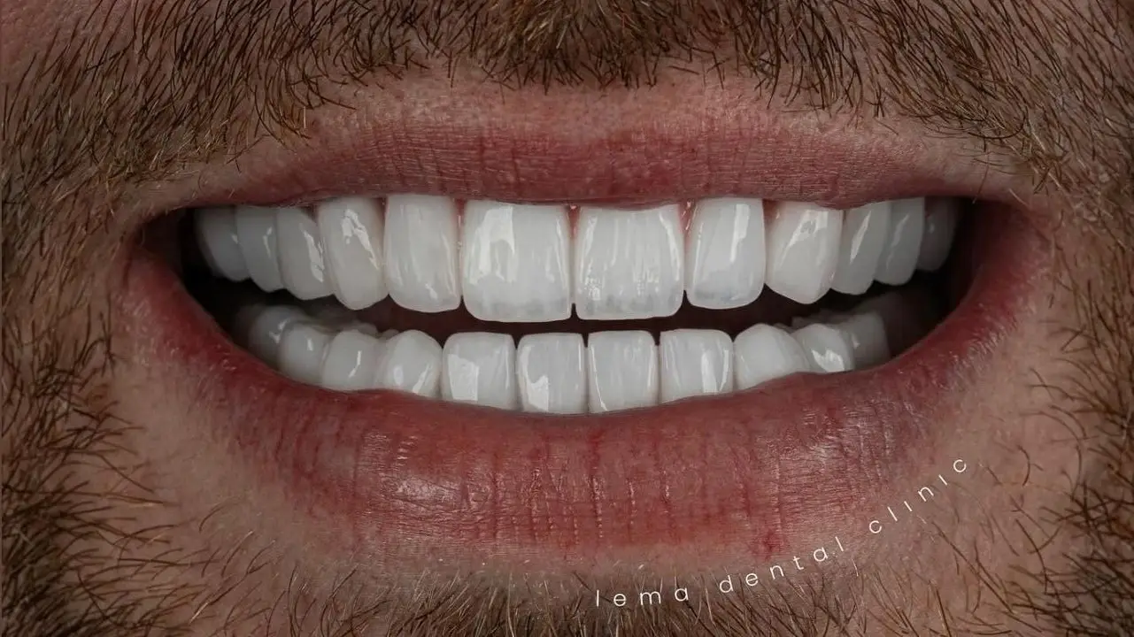 smile hollywood patient 23