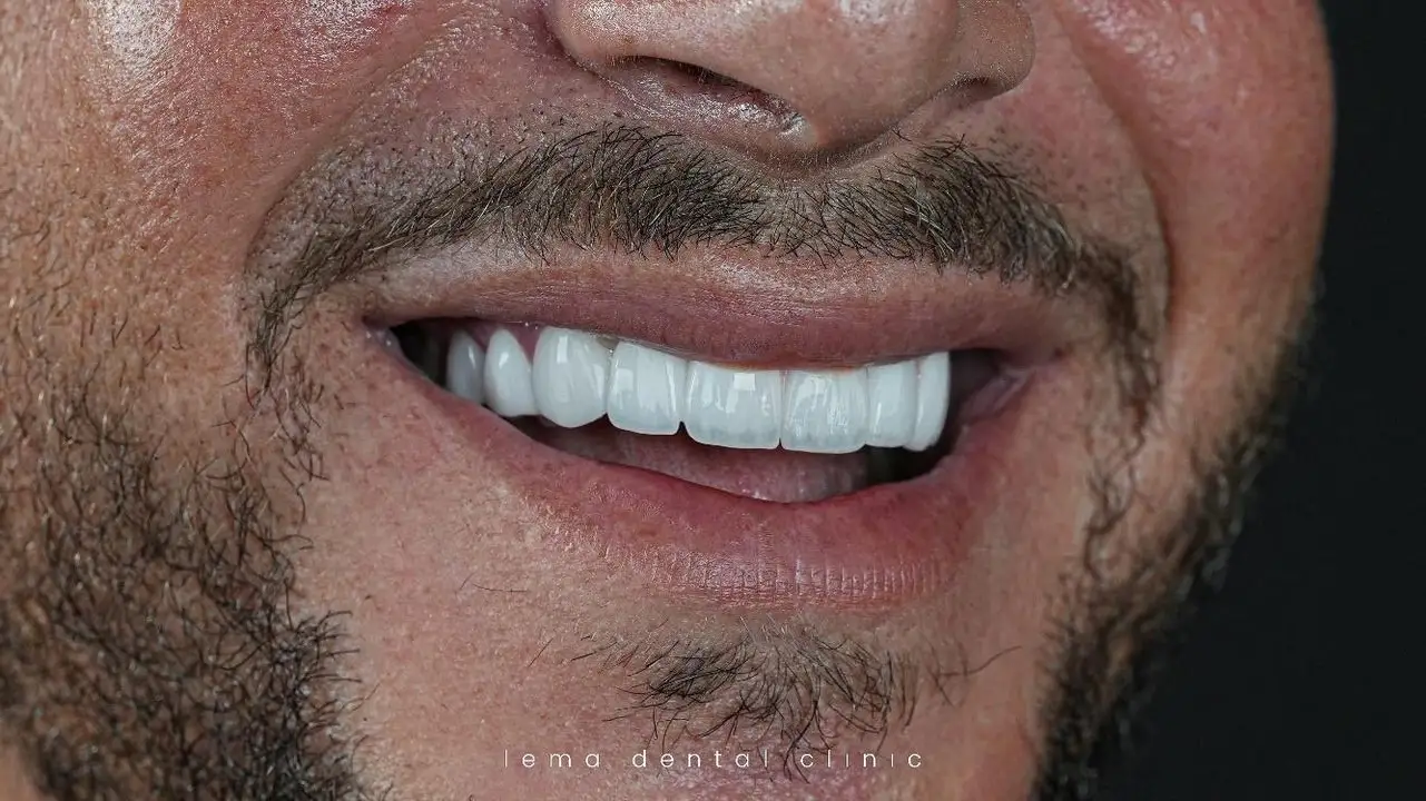smile hollywood patient 24