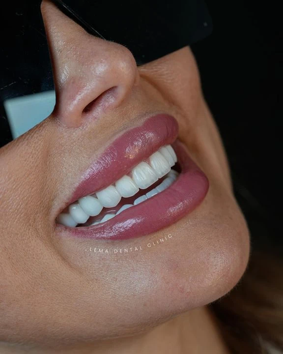 smile hollywood patient 25