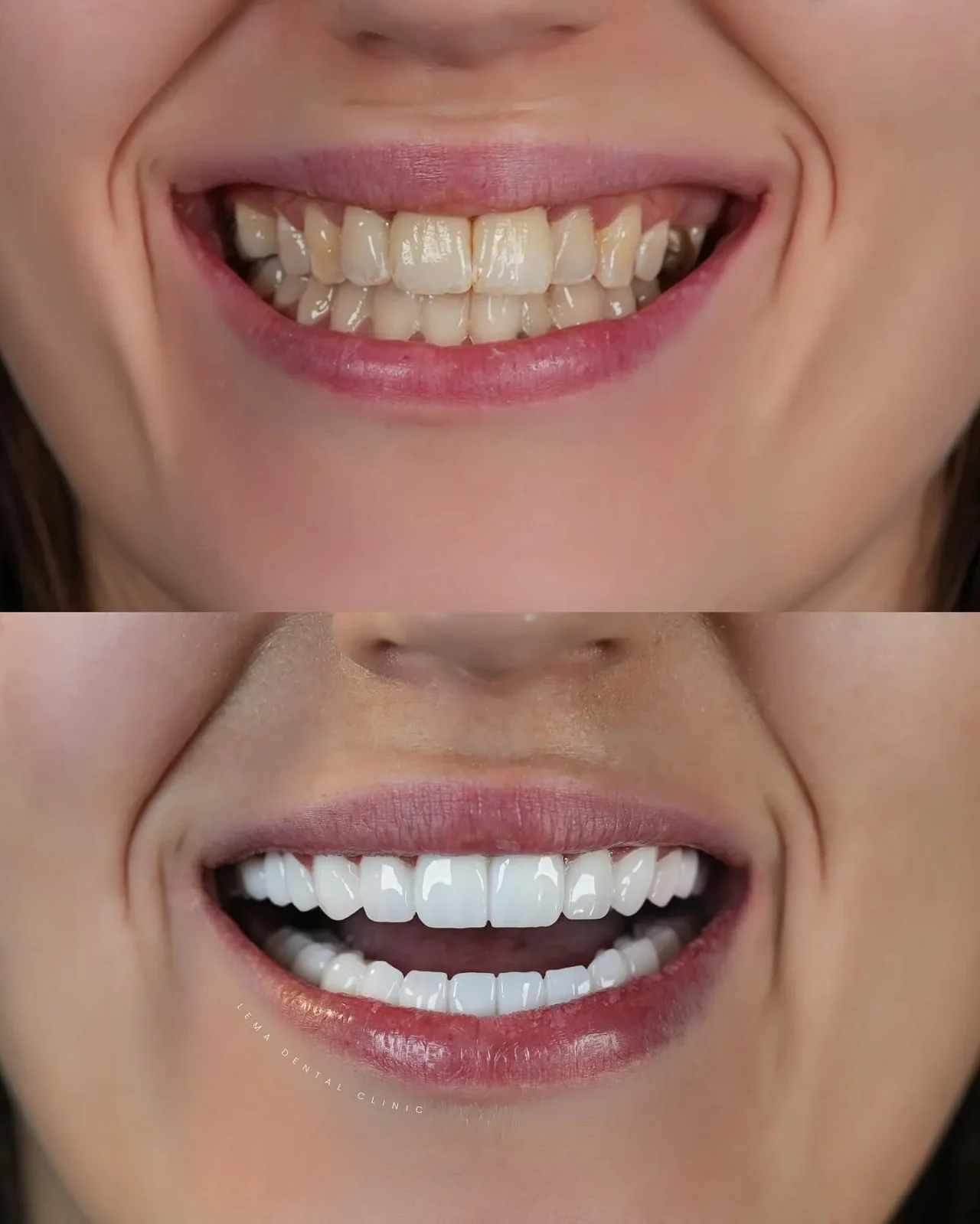 smile hollywood patient 26