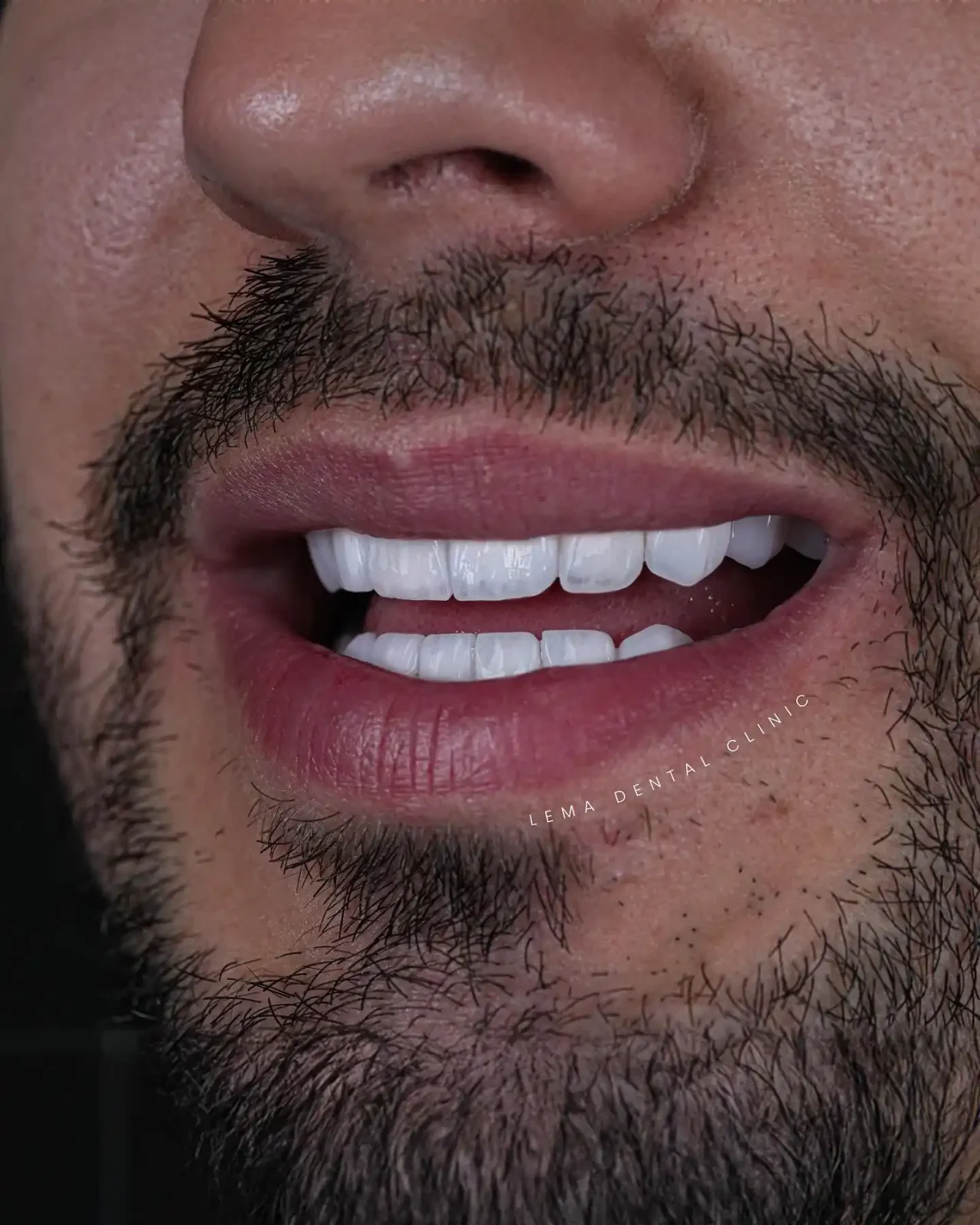 smile hollywood patient 27