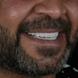 smile hollywood patient 68 smile hollywood patient 28