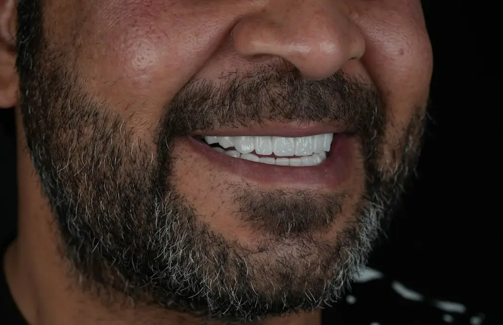 smile hollywood patient 28