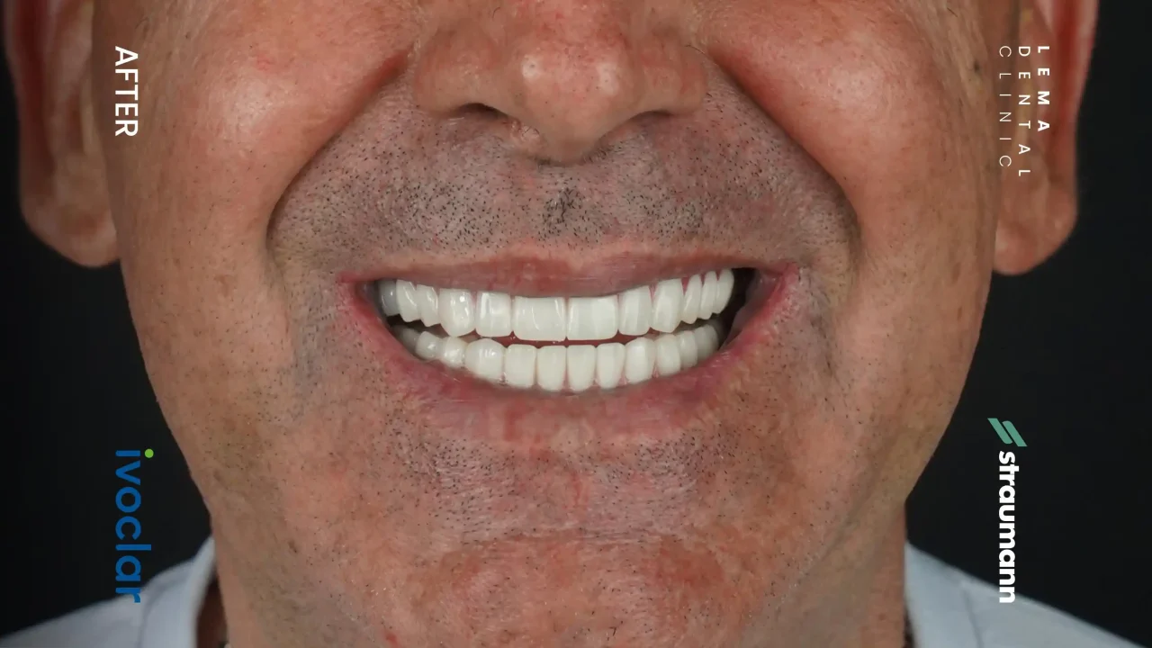 smile hollywood patient 29