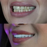 smile hollywood patient 43 smile hollywood patient 3