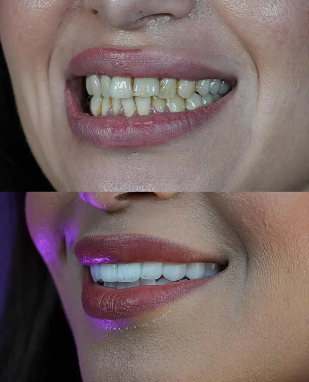 smile hollywood patient 3