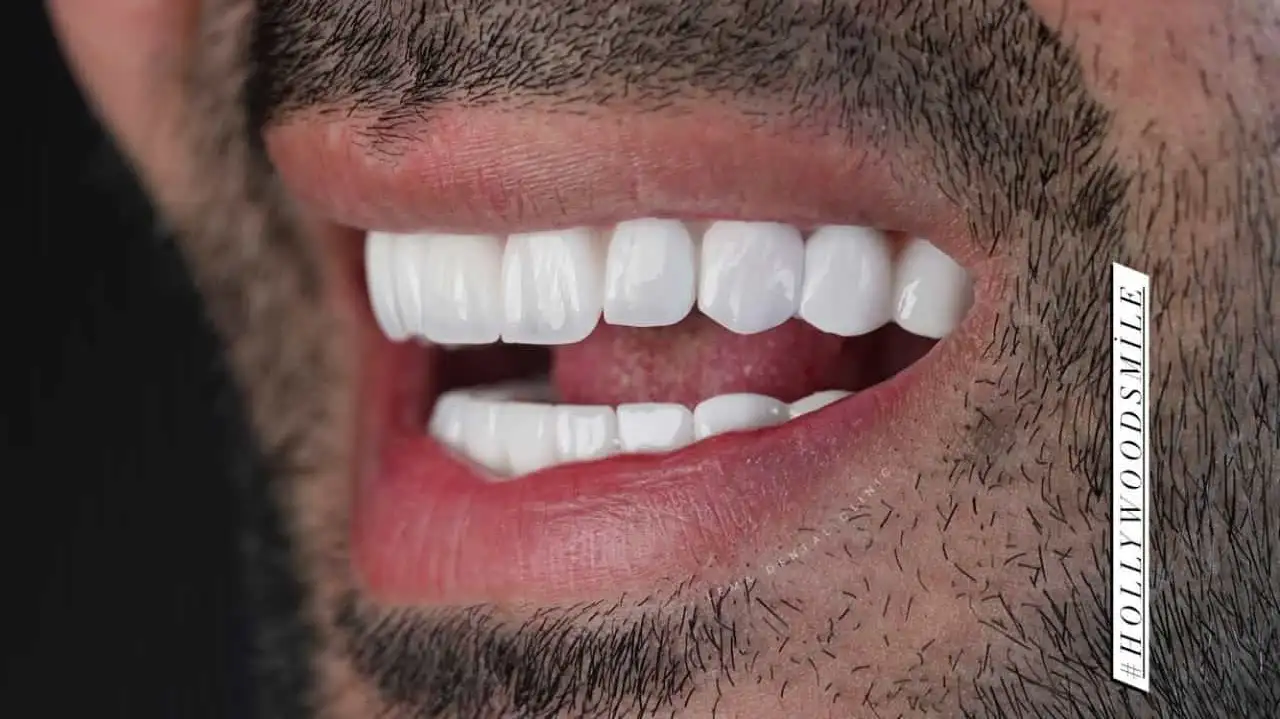 smile hollywood patient 30