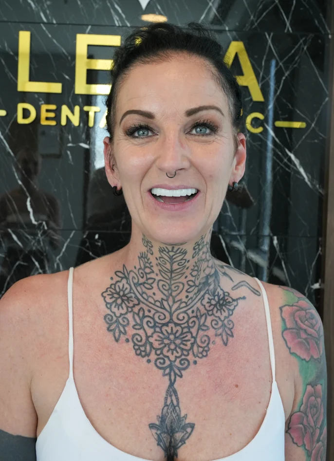 smile hollywood patient 31