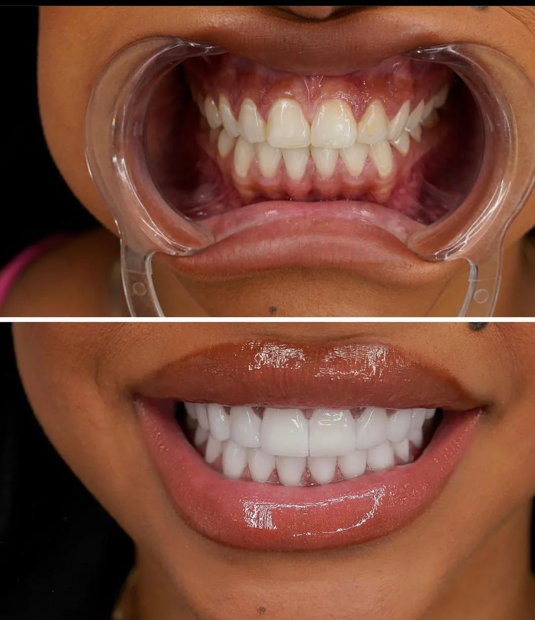 smile hollywood patient 32
