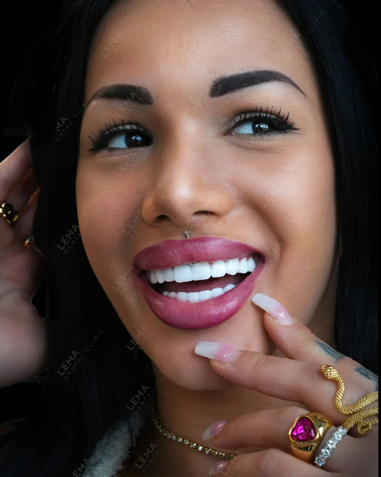 smile hollywood patient 33