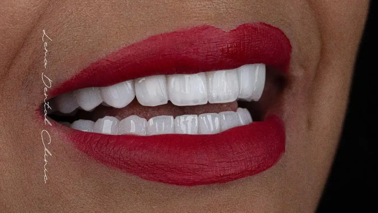 smile hollywood patient 34