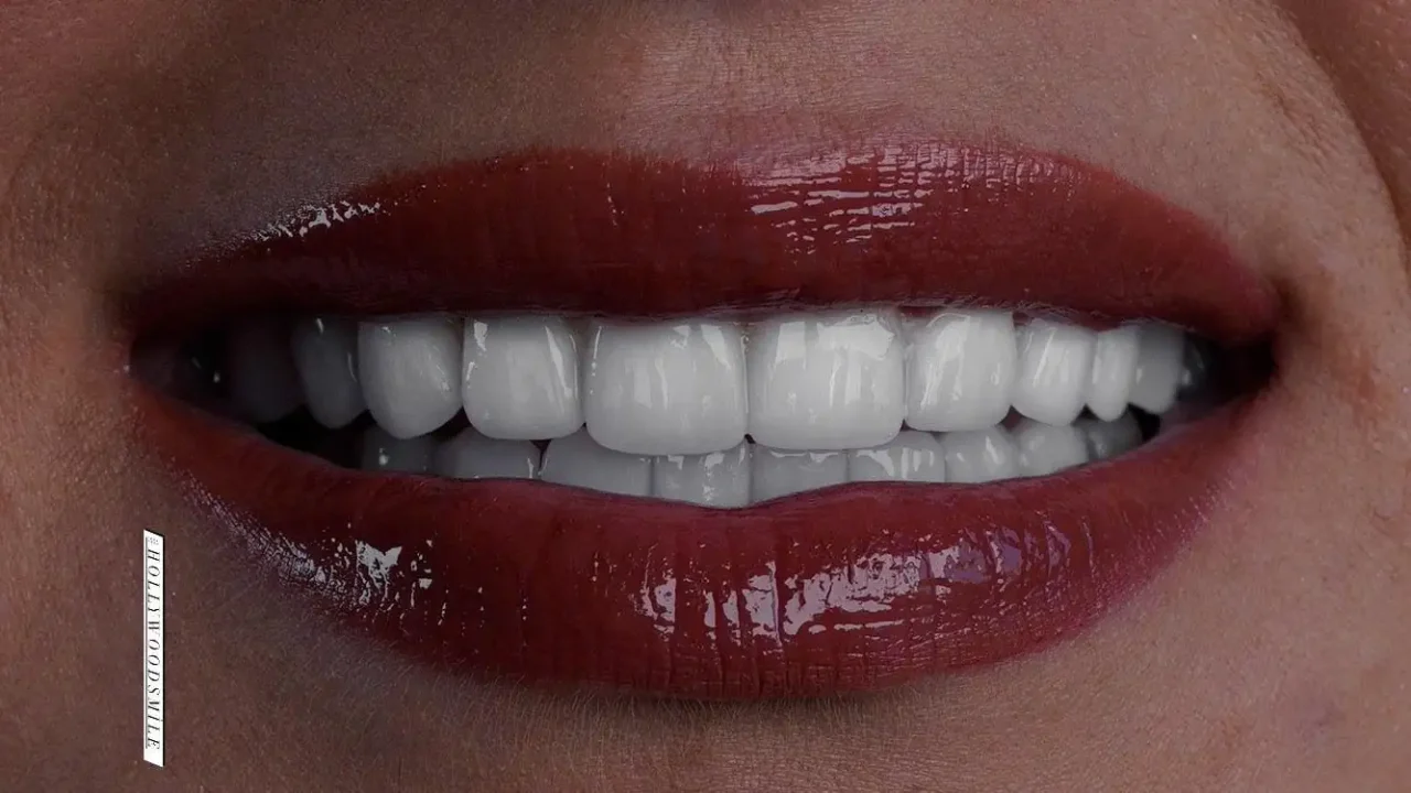 smile hollywood patient 35