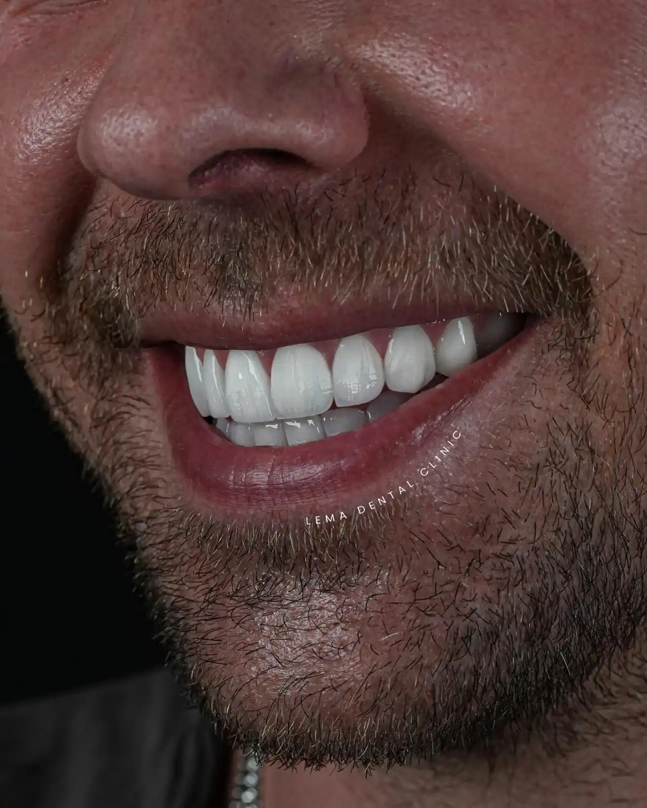 smile hollywood patient 38
