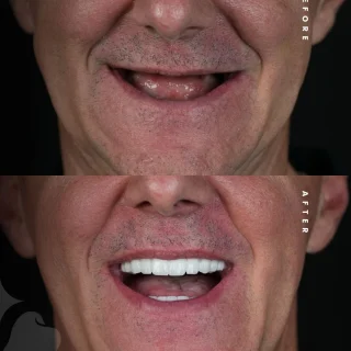 smile hollywood patient 39
