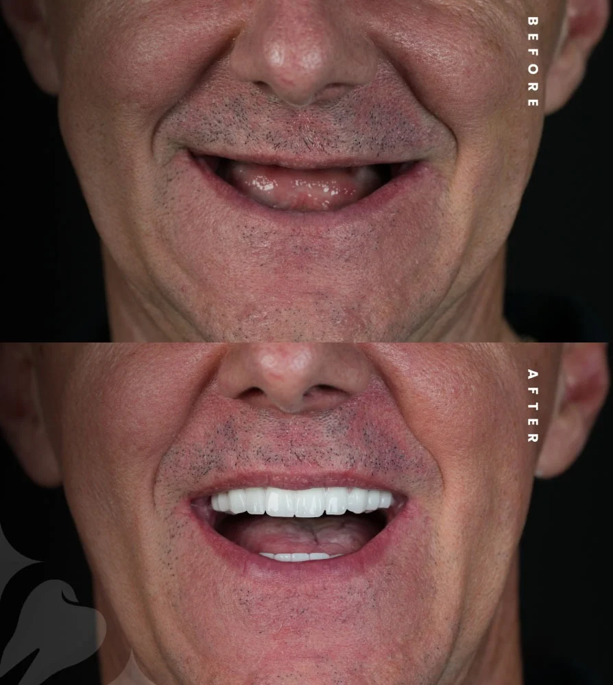 smile hollywood patient 39