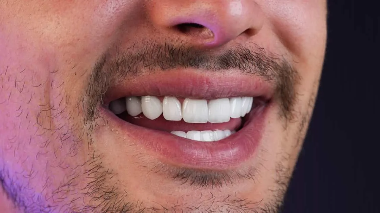 smile hollywood patient 41
