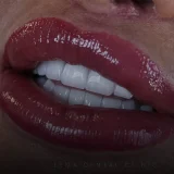 smile hollywood patient 42