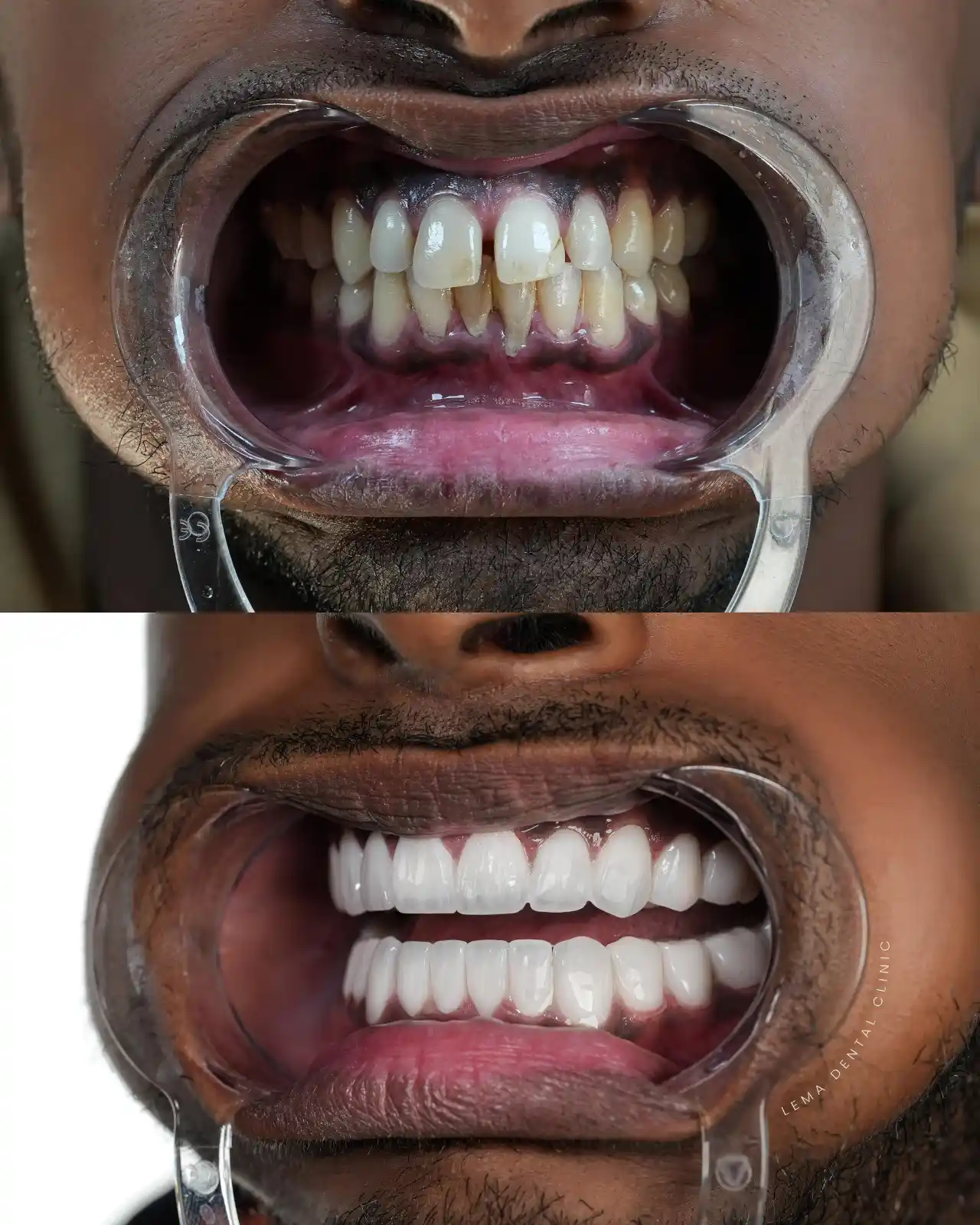 smile hollywood patient 44