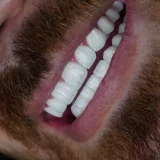 smile hollywood patient 45