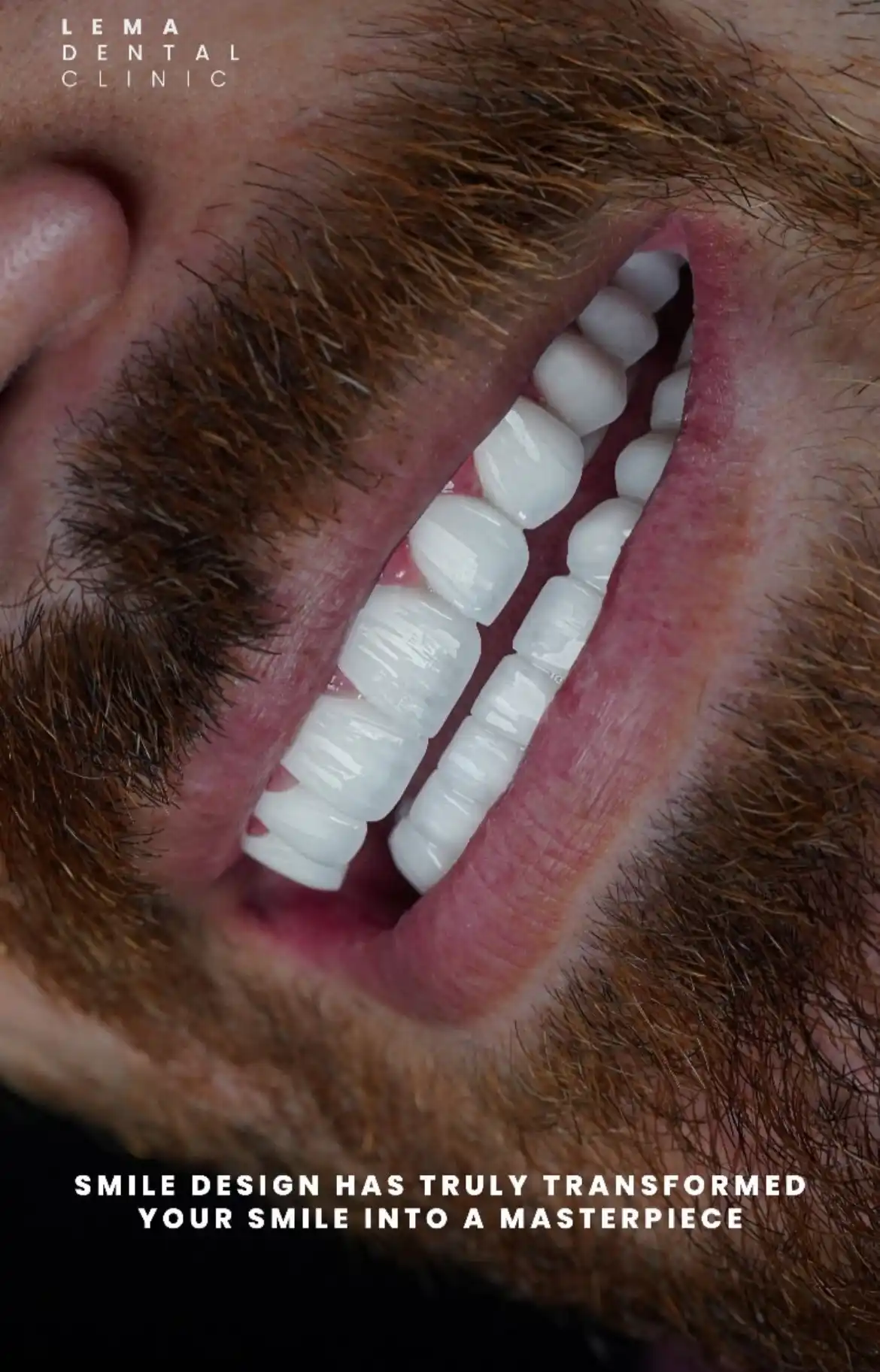 smile hollywood patient 45