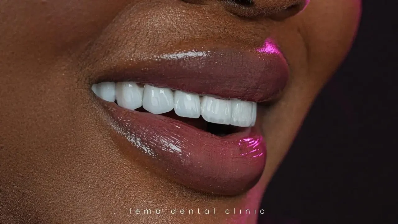smile hollywood patient 46