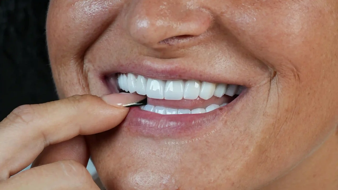 smile hollywood patient 47