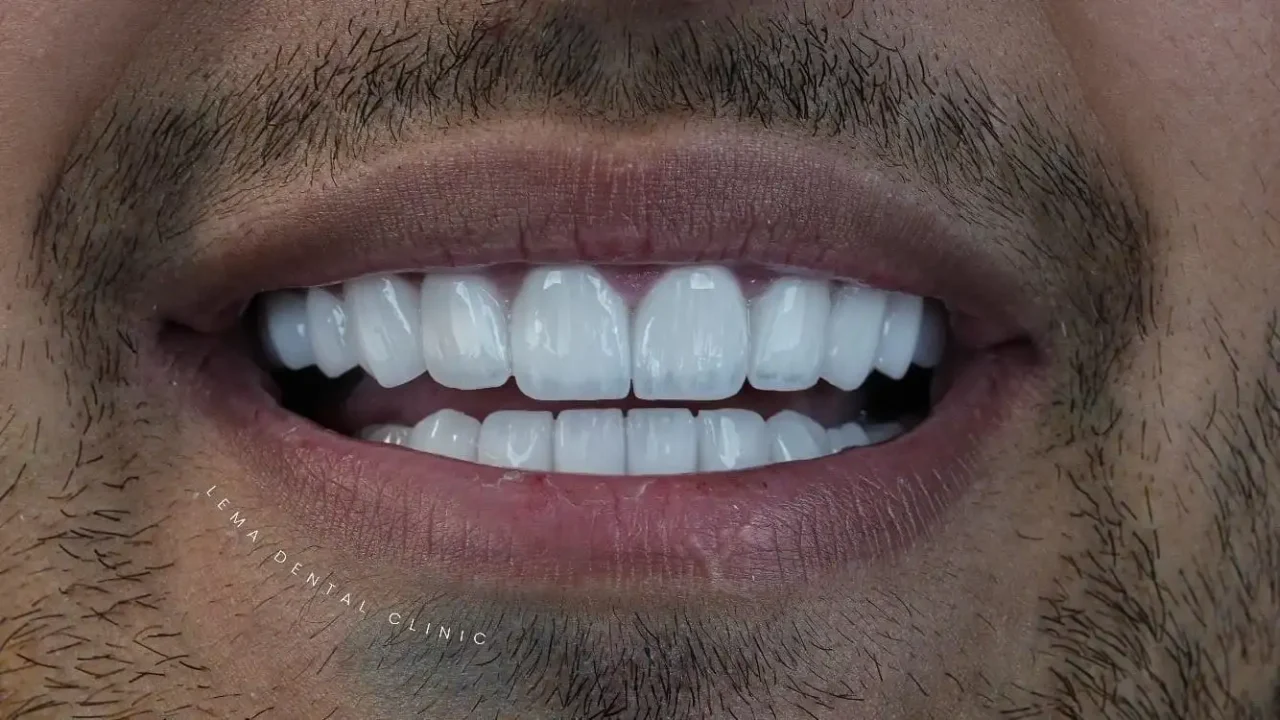 smile hollywood patient 48