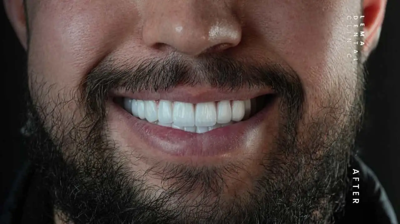 smile hollywood patient 5