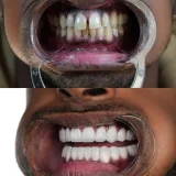 smile hollywood patient 75 smile hollywood patient 50