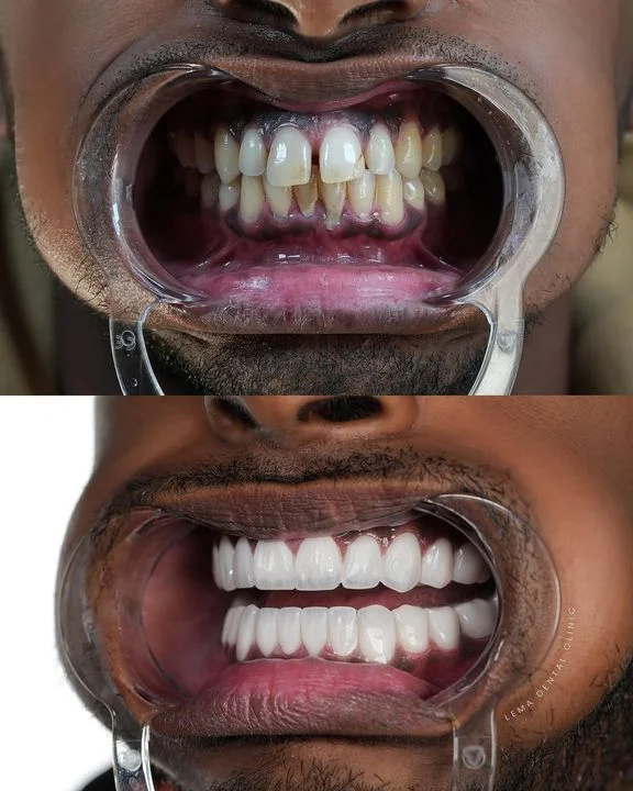 smile hollywood patient 50