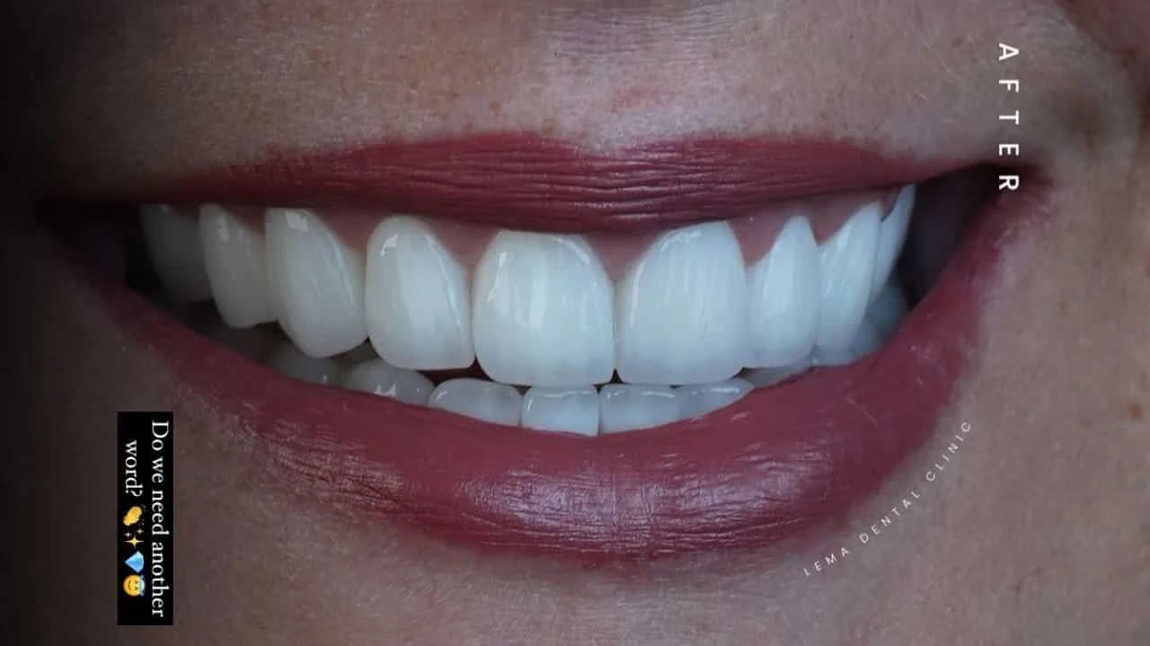 smile hollywood patient 52