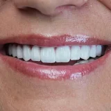 smile hollywood patient 53
