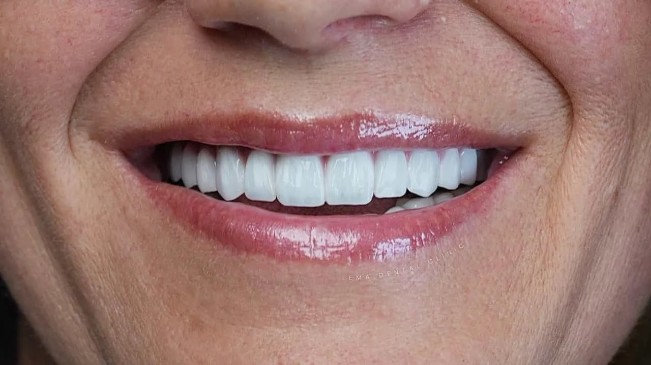 smile hollywood patient 53